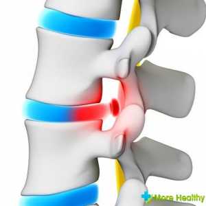 Tratamentul herniei spinării