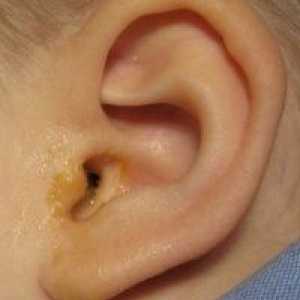 Tratamentul excreții ureche