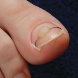 Pentru a trata o unghie incarnata nu este periculos - purta vârful degetului cu unt
