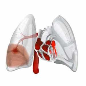 Hemoragie pulmonară: Cauze, simptome, forme, tratament