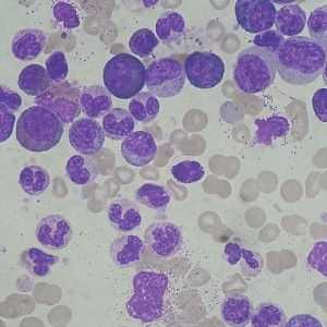 Leucocitele în urină - ce înseamnă? Cauzele de celule albe din sânge în urină.