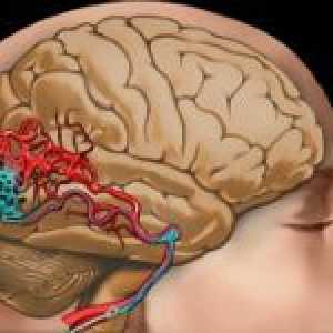 Malformație a vaselor cerebrale