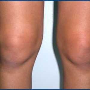 Metode de tratare a sinovita a genunchiului. Simptomele acestei boli.