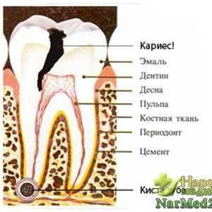 Metode de medicina tradițională în tratamentul chisturilor ale dintelui