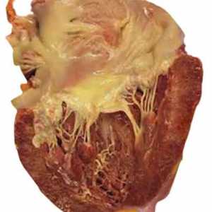 Cardio Myocardio și tratamentul acesteia