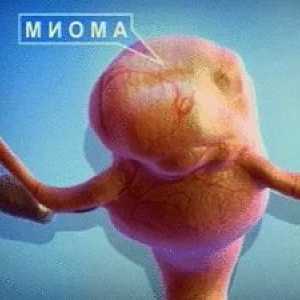 Fibromul uterin - un viclene femei inamice