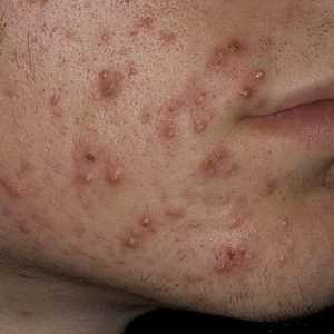 Poate exista viermi provoca acnee