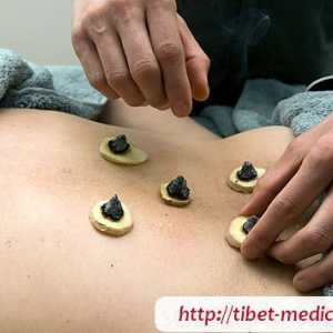 Moksoterapiya - încălzirea punctelor de acupunctura