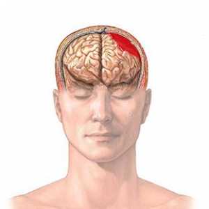 Hematom cerebral: tipuri, cauze, simptome, tratament, consecințe