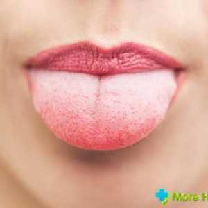 Plaque limba alb: cauze, tratamentul și prevenirea