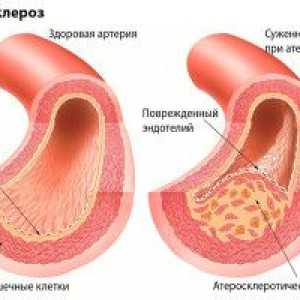 Remedii populare pentru arterioscleroză a extremităților inferioare