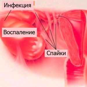 Obstrucționarea trompelor uterine: Simptome si tratament