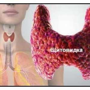 Un tiroidita autoimuna sau tiroidita Hashimoto este o glanda tiroidă