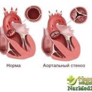 Alinarea simptome de stenoza aortica la adulți și copii