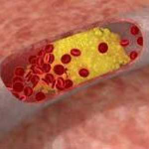 Privire de ansamblu de medicamente care reduc colesterolul din sânge