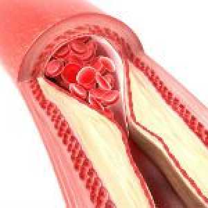 Ocluzia arterelor