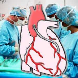 Interventii chirurgicale de by-pass coronarian pe inima: viața înainte și după