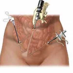 Chirurgie pentru a elimina fibrom uterin