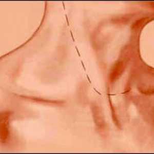 Chirurgie pentru a elimina glandei tiroide