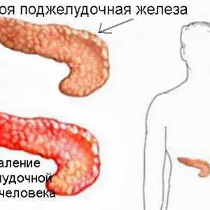 Cum este tratamentul pancreatitei cronice?