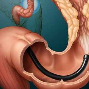 O tumoare de colon: Simptome