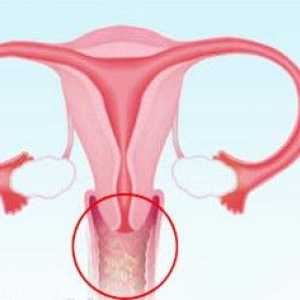 5 Cauze principale de infecție drojdie la femei
