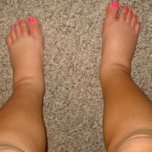 Cauzele principale ale umflarea picioarelor