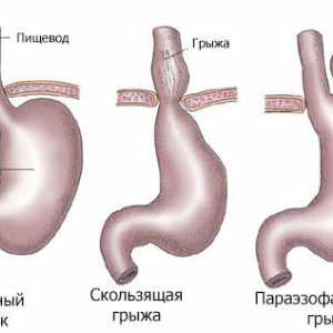 Principalele metode de vindecare herniat stomacului