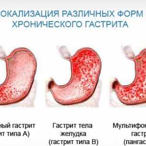 Caracteristici ale gastrită antrală și metode de tratament
