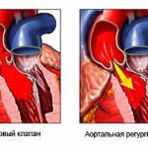 Caracteristici de insuficienta aortica si gradul