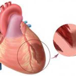 Caracteristici infarct miocardic transmural și tratamentul acestuia