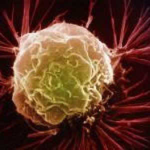 Caracteristici de leucemie cu celule păroase