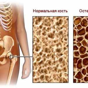 Osteoporoza - cauza principala a fracturilor