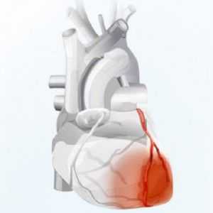 Sindrom coronarian acut: cauze, factori de risc, tratament, forma cronica a bolii