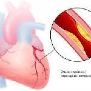 Sindrom coronarian acut