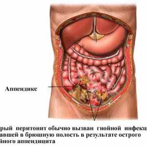 Cauze și simptome de peritonită acută