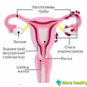 Endometrioza 1 grad