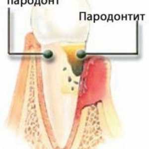 Parodontita - cauze și soluții la problemele
