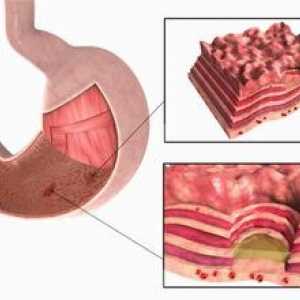 Ulcer peptic