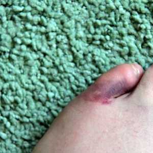 Fractura degetului mic de la picior: simptome și tratament
