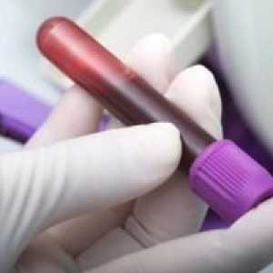 Testele pentru artrita reumatoidă: pregătirea, procedura și interpretarea rezultatelor