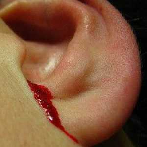 De ce este sângerarea din ureche