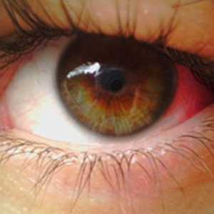 De ce izbucni capilarele în ochi? Cauze și prevenirea
