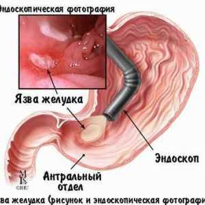 Este posibil de a vindeca ulcer gastric și ulcer duodenal medicament?