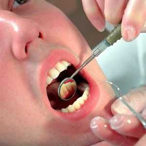 Am urcat de-a lungul gingiilor dinte: cum să-l vindeca?