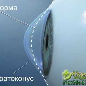 Apariția ochilor keratoconus și modalități de a elimina
