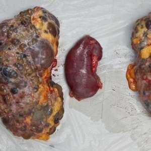 Ce este boala de rinichi polichistic? Există modalități de recuperare
