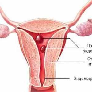 Polipi endometriali