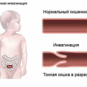 Consecințele obstructie intestinala la sugari