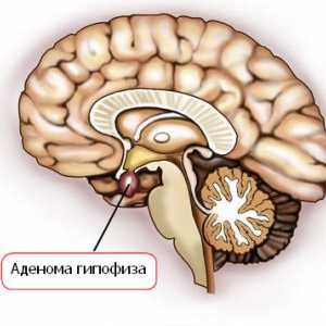 Care sunt simptomele de adenom pituitar